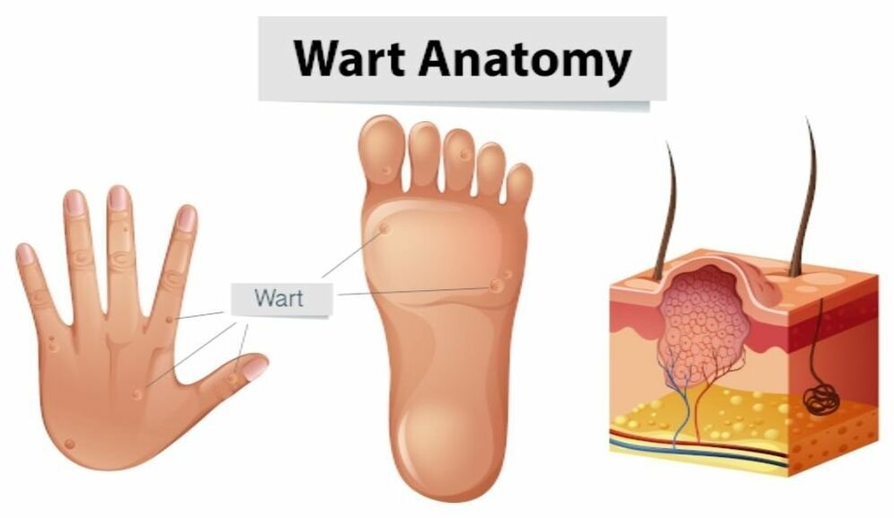 Erfollegräich Entfernung vu Warzen zesumme mat der Wuerzel mat Removio