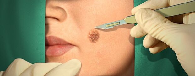 Chirurgesch Behandlung vu Papilloma