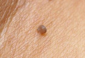 Klinesch Bild vu Papilloma
