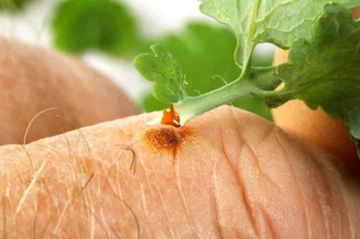 wéi Dir Papillomas mat Folk Remedies ewechhuelen