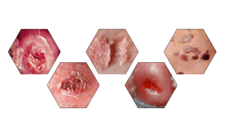 Firwat sinn Papillome geféierlech