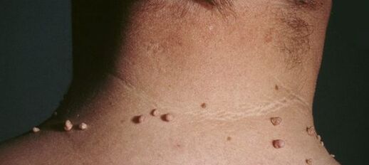 wéi vun papillomas lass ze kréien