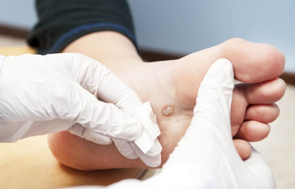 firwat erschéngen Warzen um Kierper