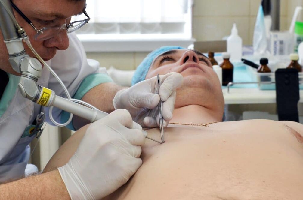 wéi vun warzen op de Kierper lass ze kréien