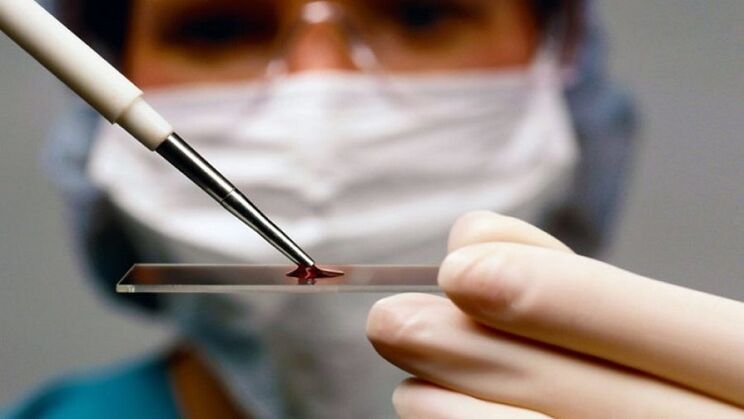 Diagnos vum Mënsch Papillomavirus