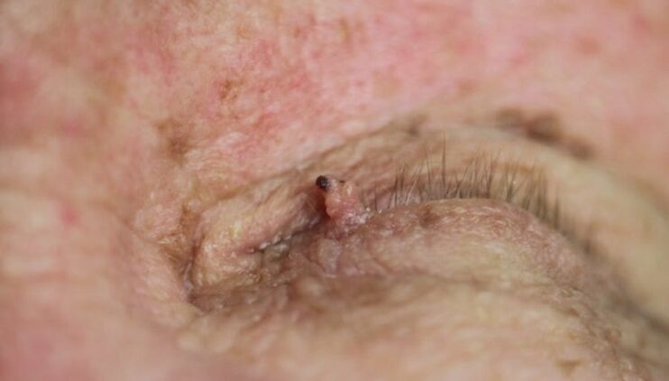 papilloma op der eyelid wéi et lass ze ginn