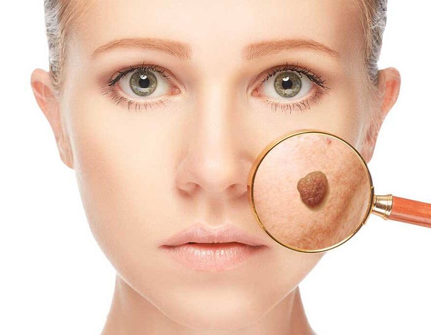 Papilloma am Gesiicht