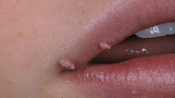 Papillome op de Lippen