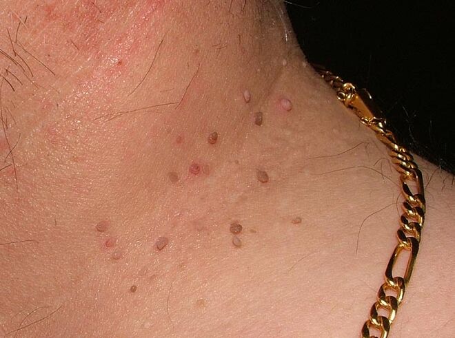 Papillome um Hals