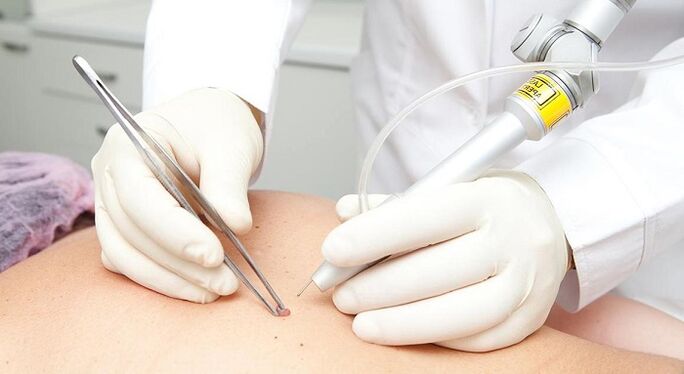 Laser Entfernung vu Papillome fir Papillomavirus